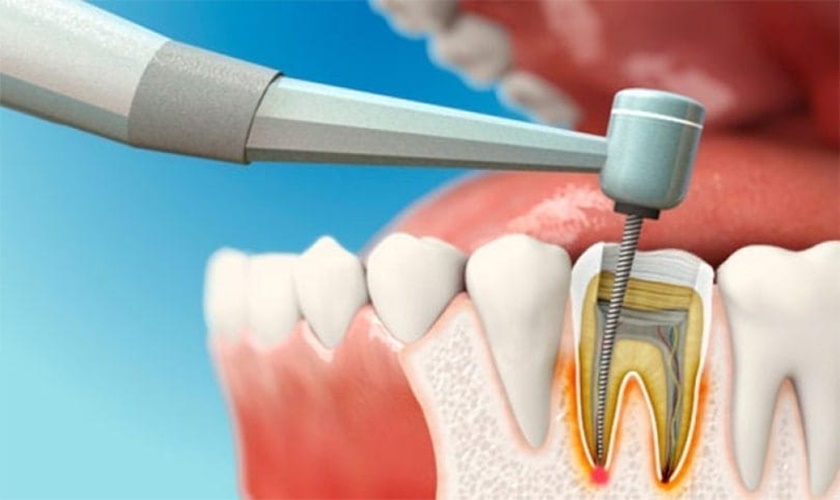 Điều Trị Tủy Răng Có Đau Không?