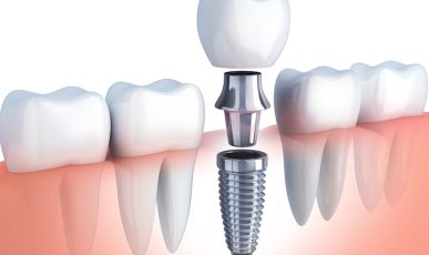 trong-rang-cam-ghep-rang-implant